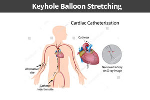 Cardiac Catheter