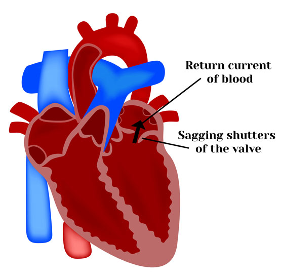 Mitral Valve