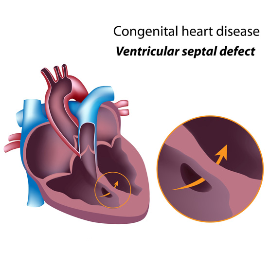 VSD Heart