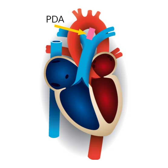 PDA